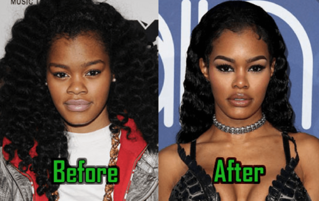 Teyana Taylor Before Surgery Did She Get Her Face Done?