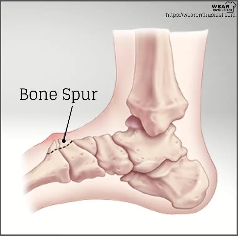 Why Do Vionic Shoes Hurt My Feet? Guide)