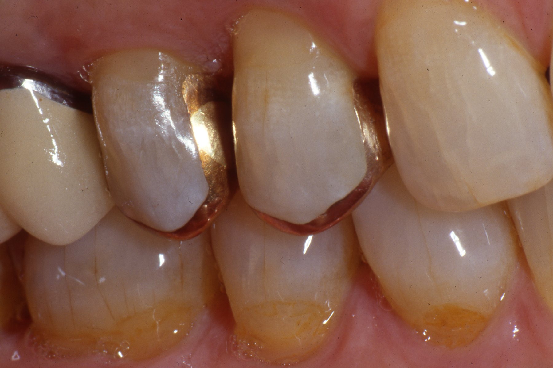 Dental Gold Onlays and Crowns Posterior Teeth V.6 The Center for