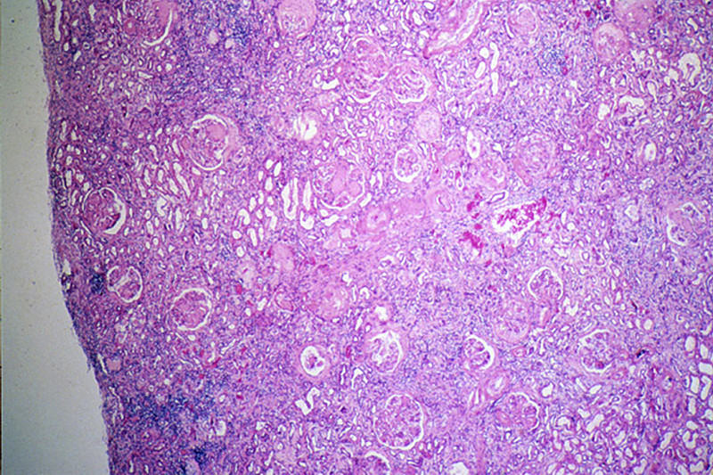 Duke Pathology Week 14 Renal Pathology