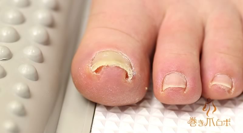 Este Aparato Cura las Uñas Enterradas o Encarnadas sin Dolor