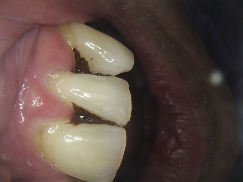 Cavity vs Stain What's the Difference?  DMD