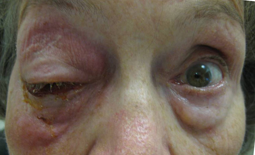 Orbital Pseudotumor. Ophthalmology The University of Iowa