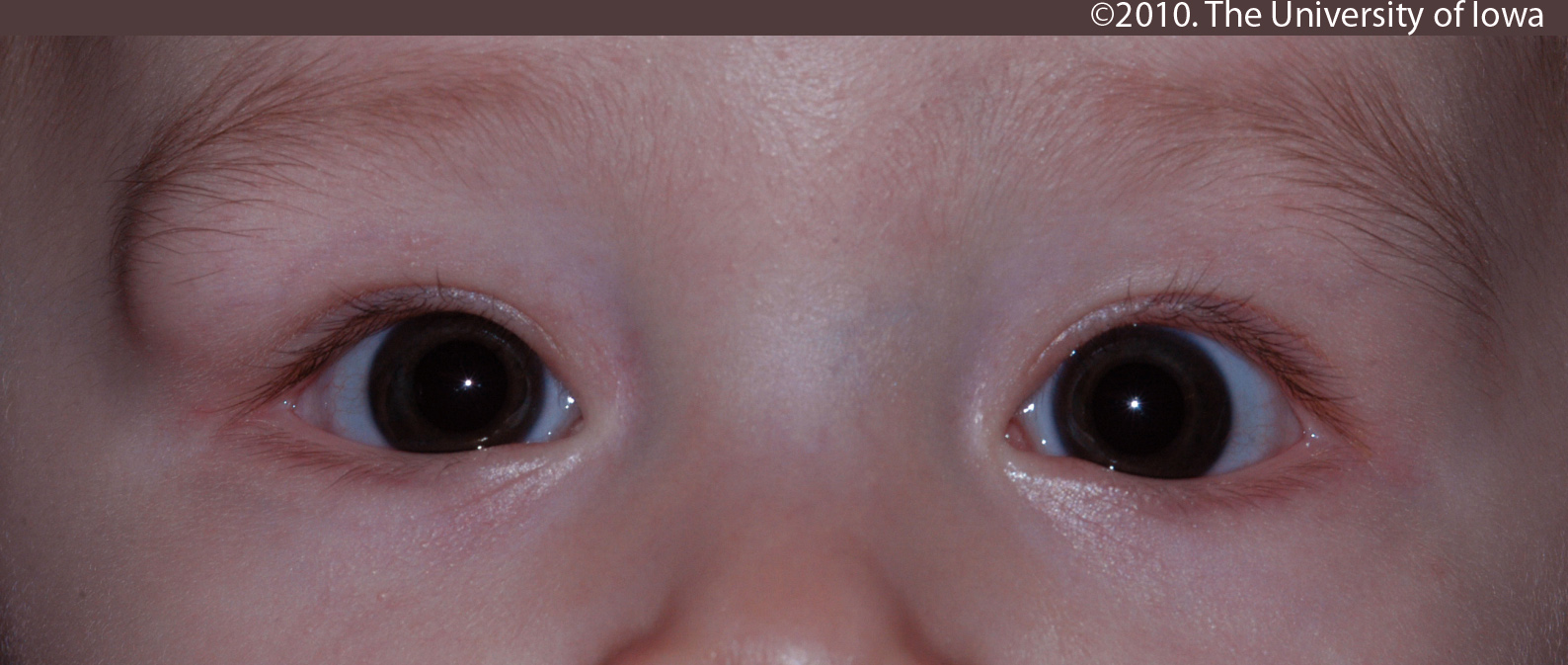 Dermoid Cyst. Ophthalmology The University of Iowa
