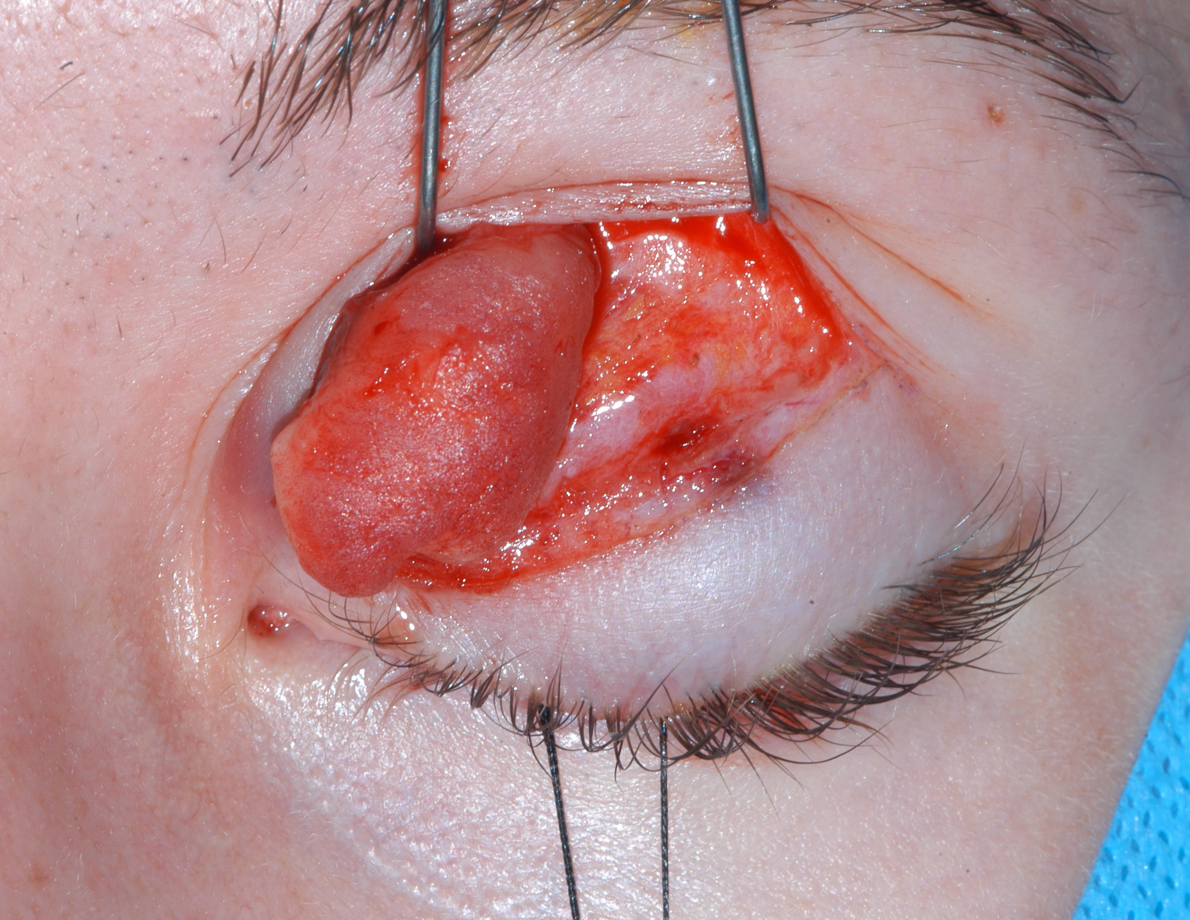 Orbital Osteoma