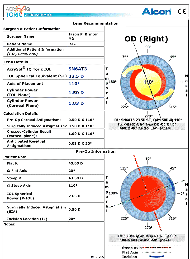 Phacoemulsification Considerations for Astigmatism Management