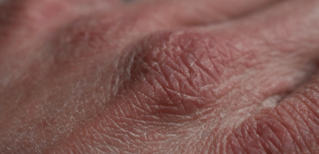 7 Alarming signs of Vitamin C deficiency