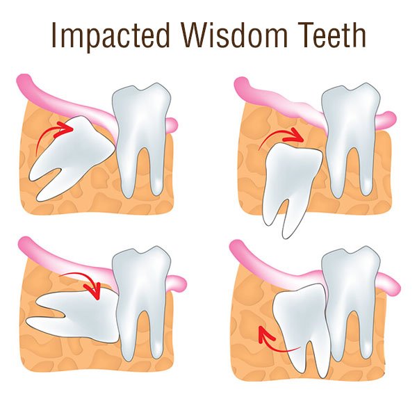 Wisdom Teeth Do You Need Them Impacted Wisdom Teeth, Back Molars