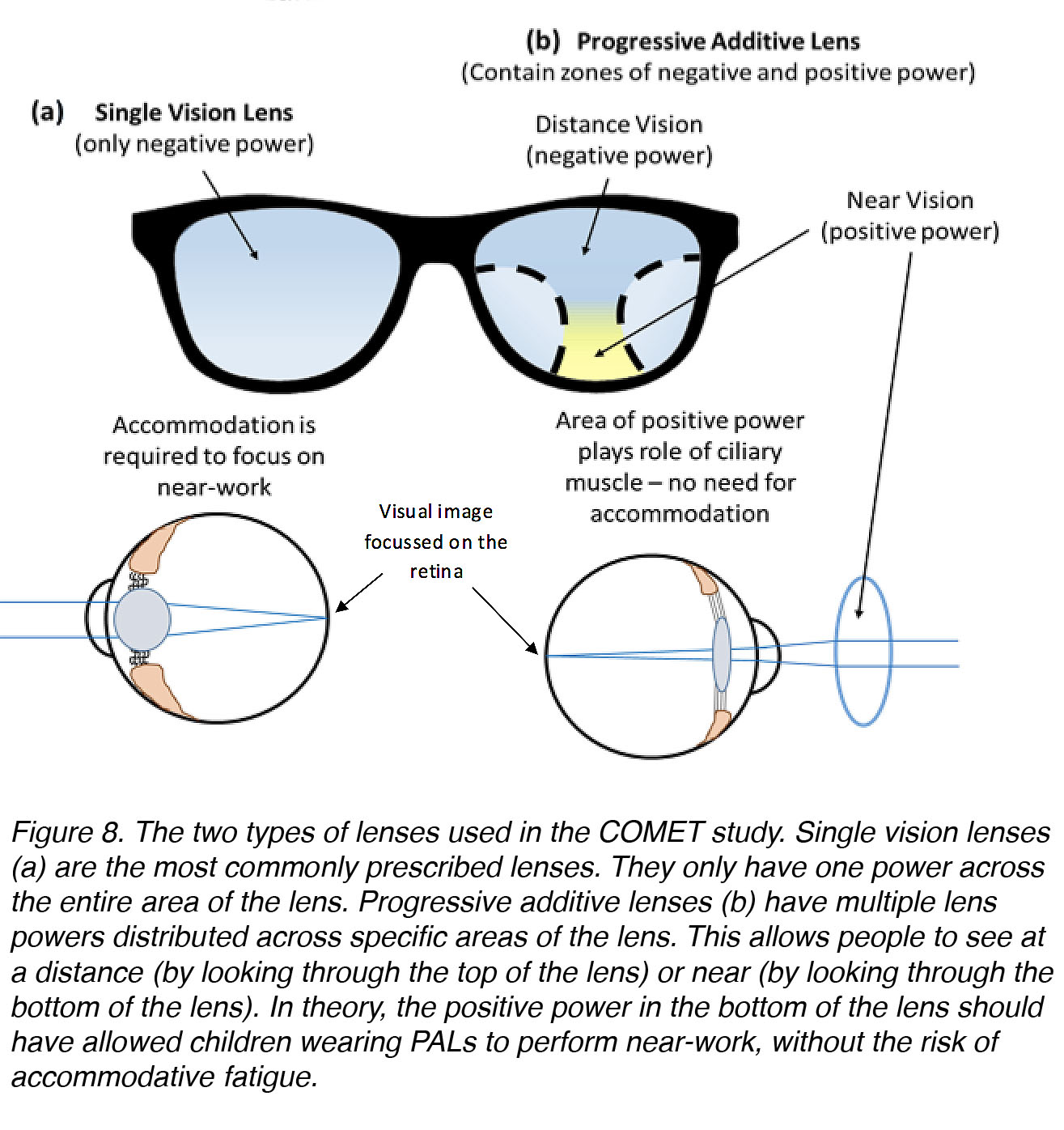 The Science Behind Myopia. Brittany J. Carr and William K. Stell