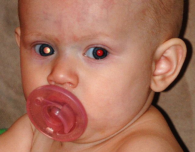PhotoRED Know the Glow and Check for Normal Fundal Reflex in Children