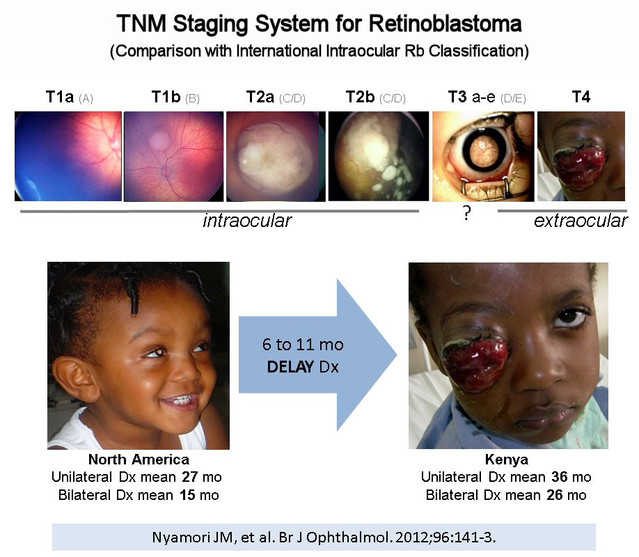 Staging Intraocular Retinoblastoma WE C Hope