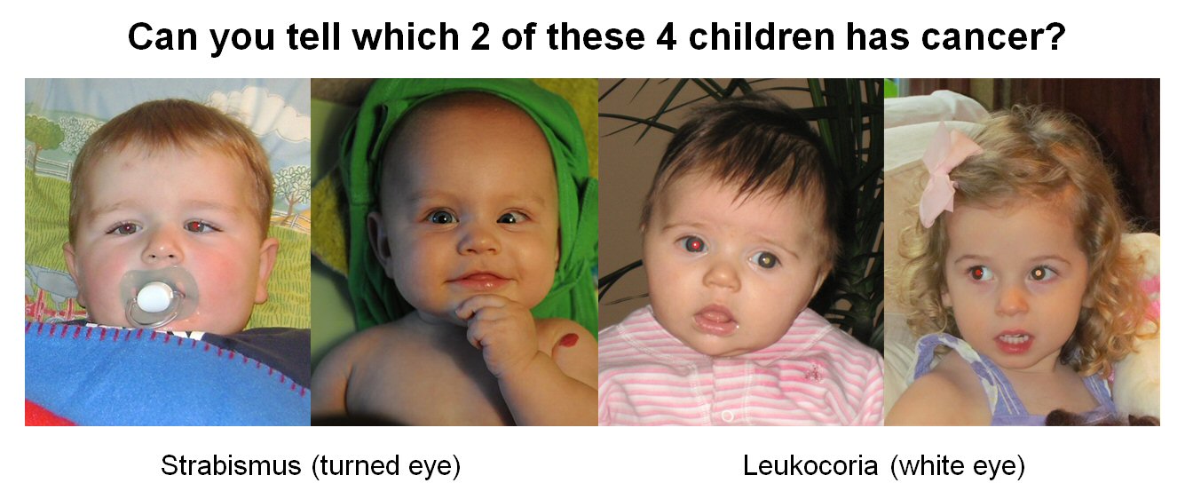 Signs and Symptoms of Retinoblastoma WE C Hope