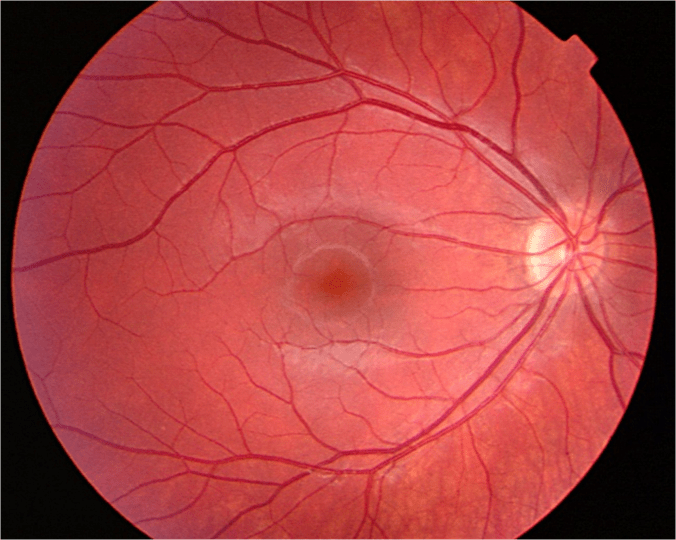 White Eye AFTER Retinoblastoma WE C Hope