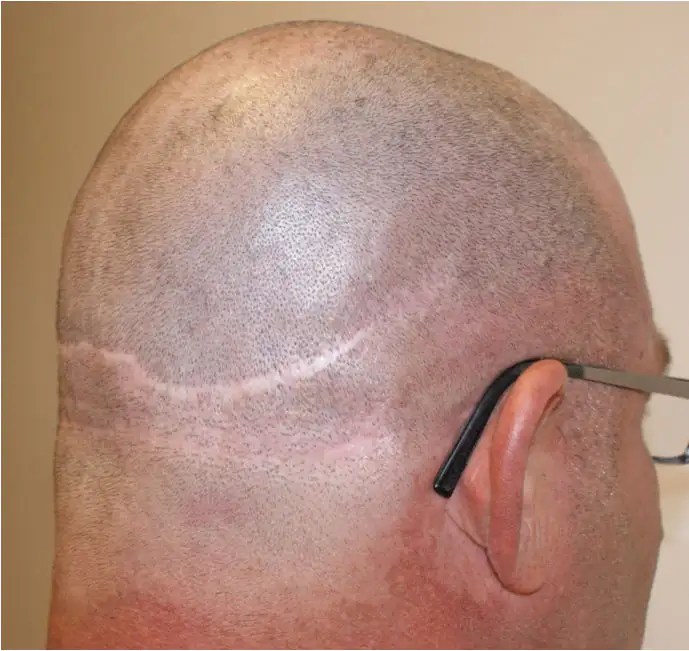 hair transplant scar