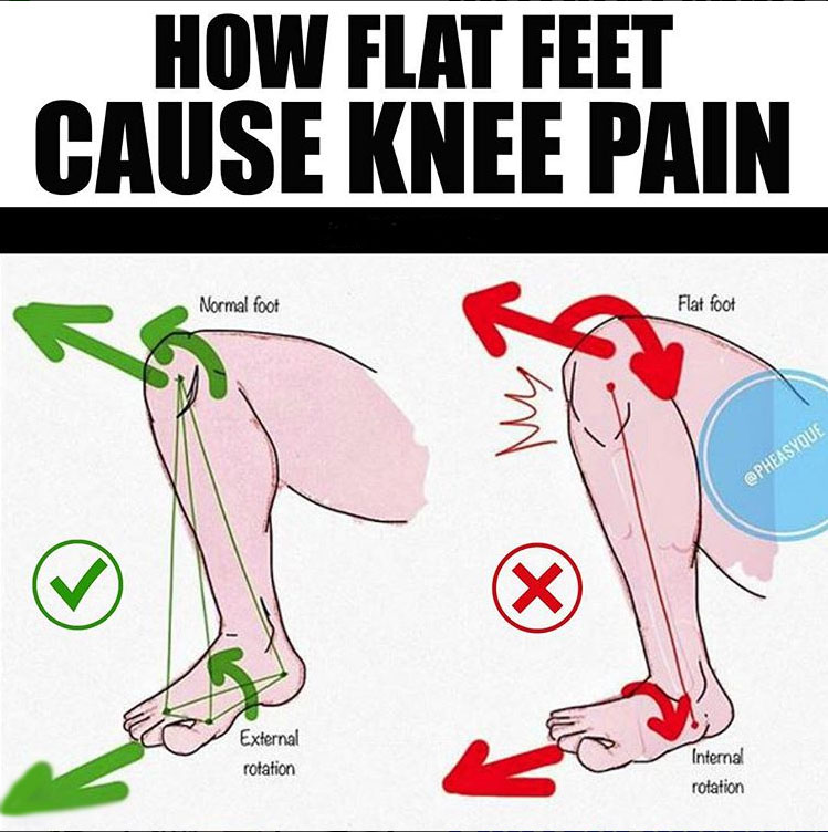 HOW FLAT FEET CAUSE KNEE PAIN