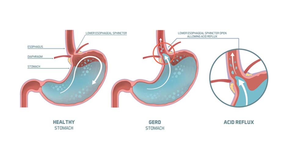 Throwing Up After Linx Surgery at Charles Mckeown blog