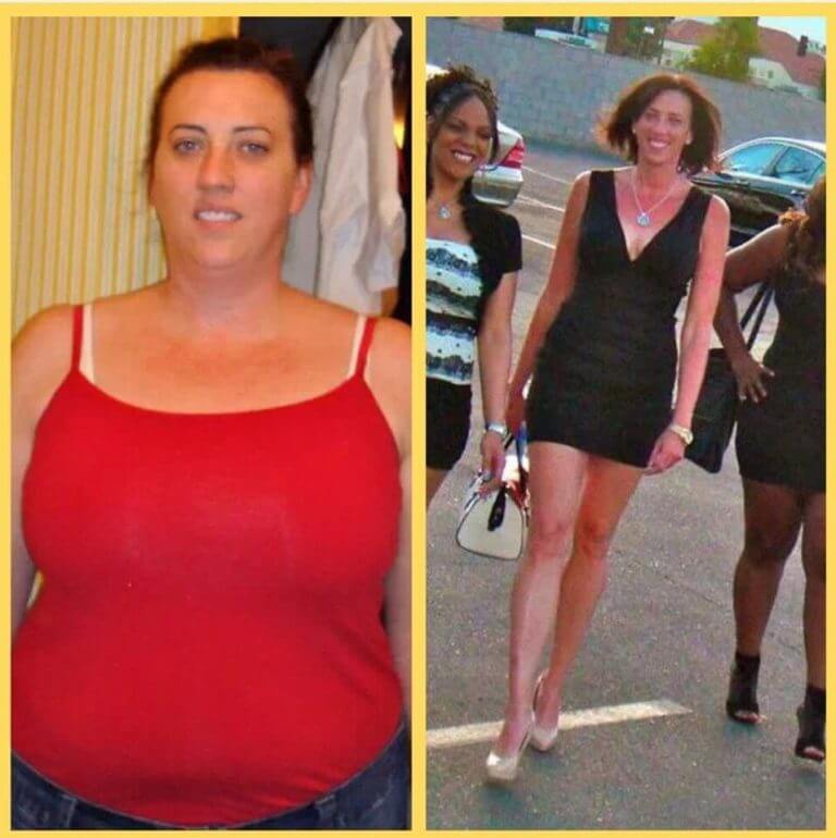 Bariatric Revision Procedures at the Weight Loss Surgery Center of LA