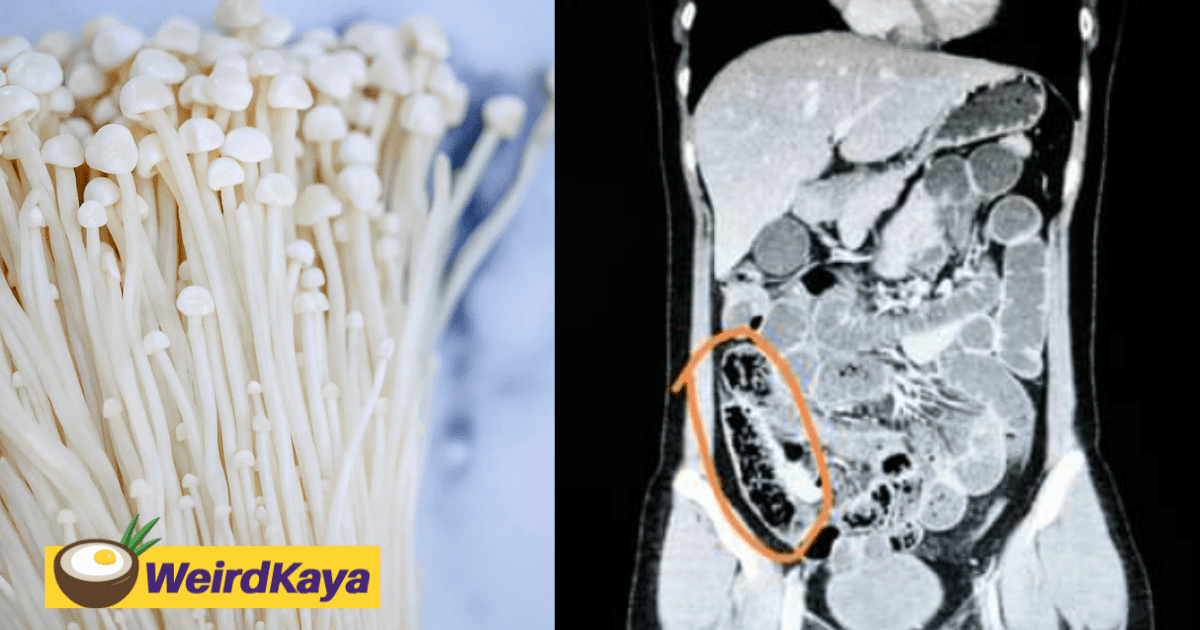 35yo woman admitted to hospital after eating too much enoki mushrooms
