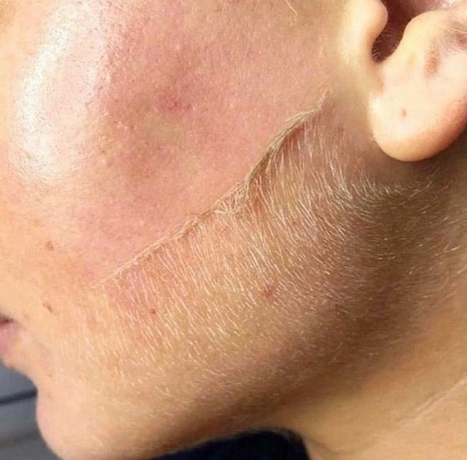 Dermaplaning Well House Wellness and Aesthetic Services