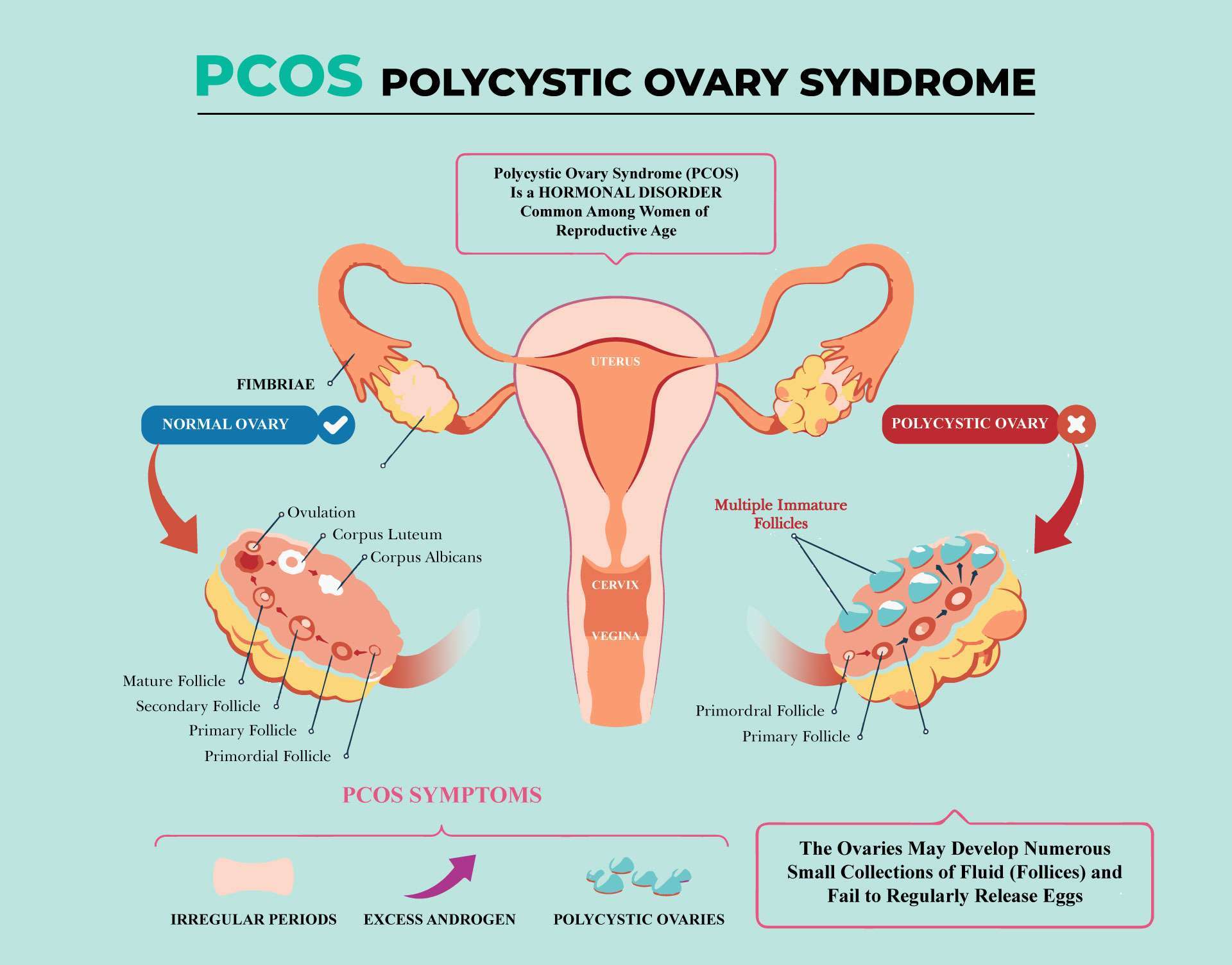 PCOS: All you need is the right guidance - Wellfinity