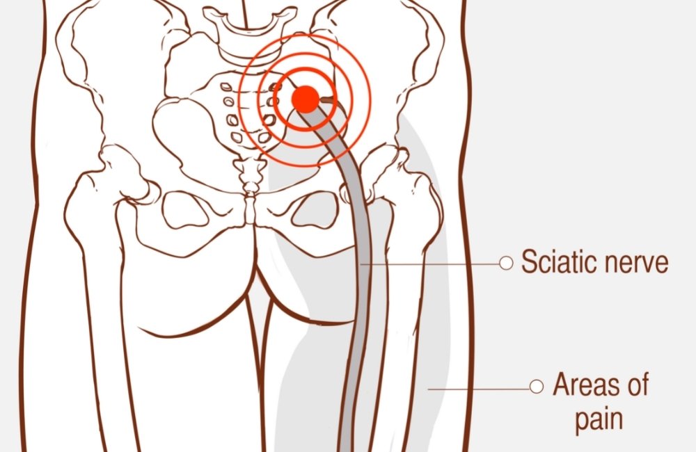 5 Effective Stretches to Relieve Sciatic Hip, Lower Back, and Leg Pain