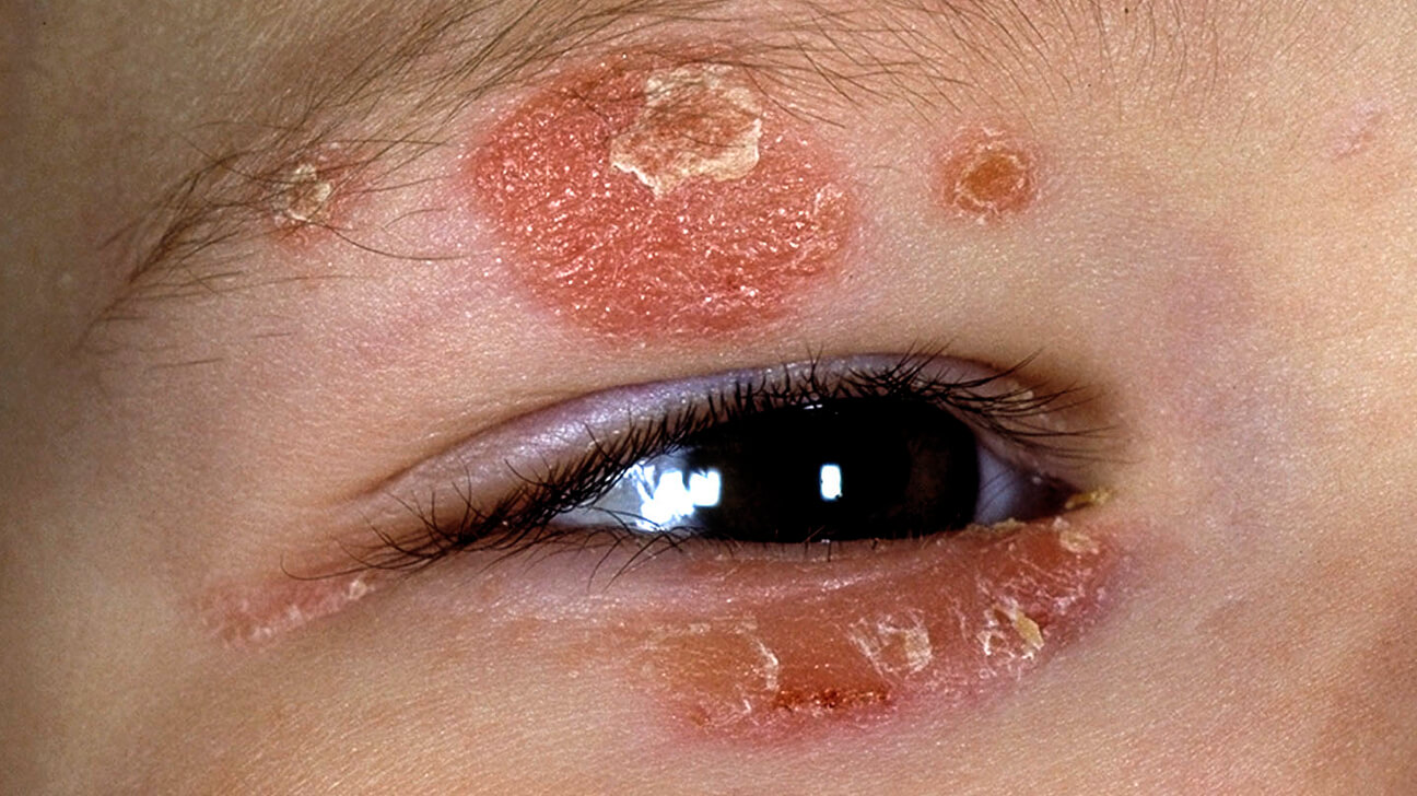 Facial Psoriasis Symptoms, Causes & 10 Best Treatment Options in 2021