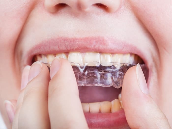 Here's What You Should Know When Your Child Gets Braces Be Your Best