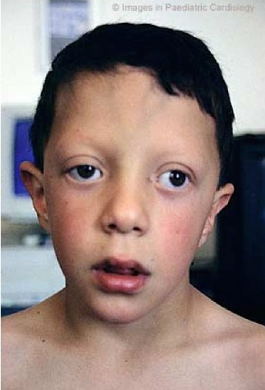 متلازمة نونان مجموعة الدعم الأسري لمتلازمات الوراثية و الخلقية متلازمة