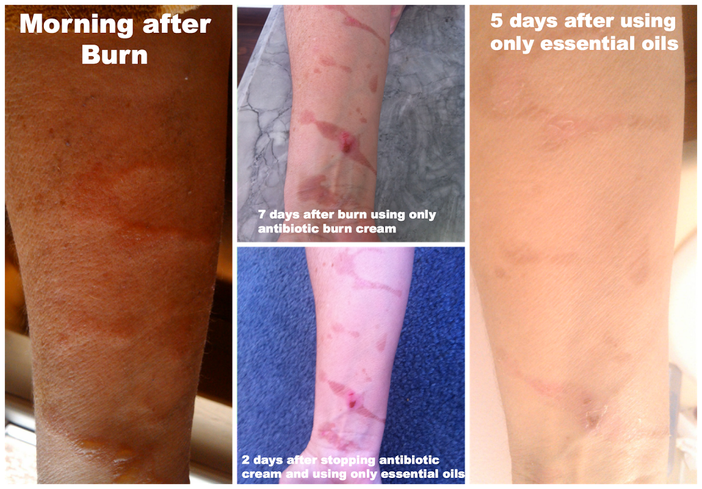 DIY Burn or Scar Ointment using Essential Oils We're Parents