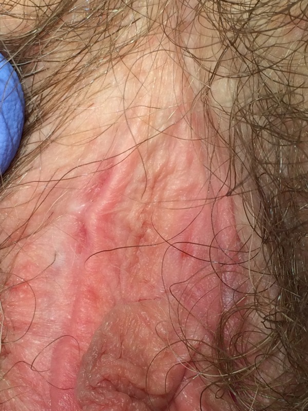 Lichen Sclerosus Und Lichen Planus Der Vulva | Prof. Dr. Med. Werner Mendling