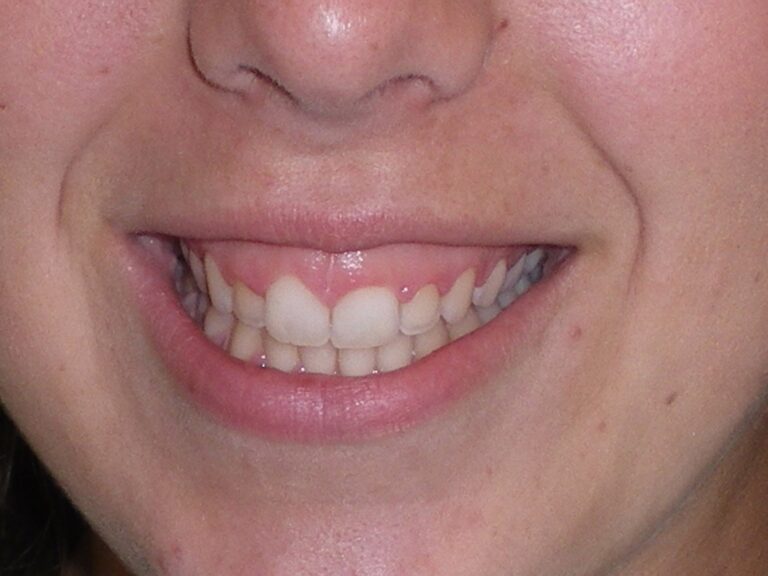 Gingival Sculpting Dr.Harvey Miller and Dr.WonGi Lee, Dental Implant