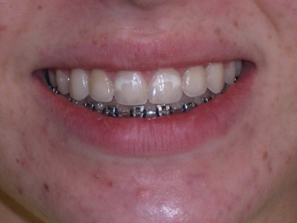 Gingival Sculpting Dr.Harvey Miller and Dr.WonGi Lee, Dental Implant