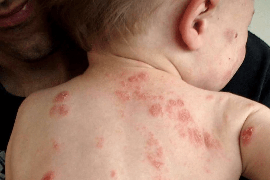 Eczema Skin Treatment Allergy Specialist Melbourne
