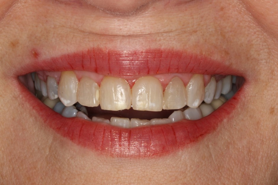 Invisalign and Braces Columbus Westerville Dental Center