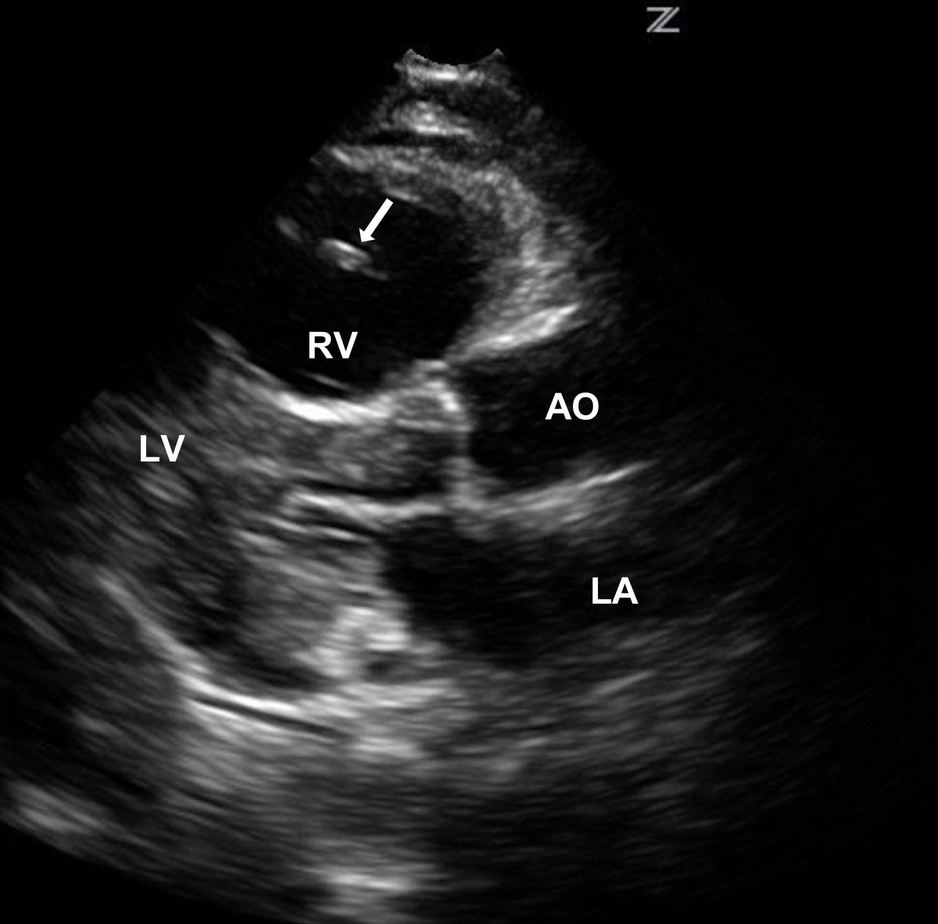 Bedside Echocardiography for Undifferentiated Hypotension Diagnosis of