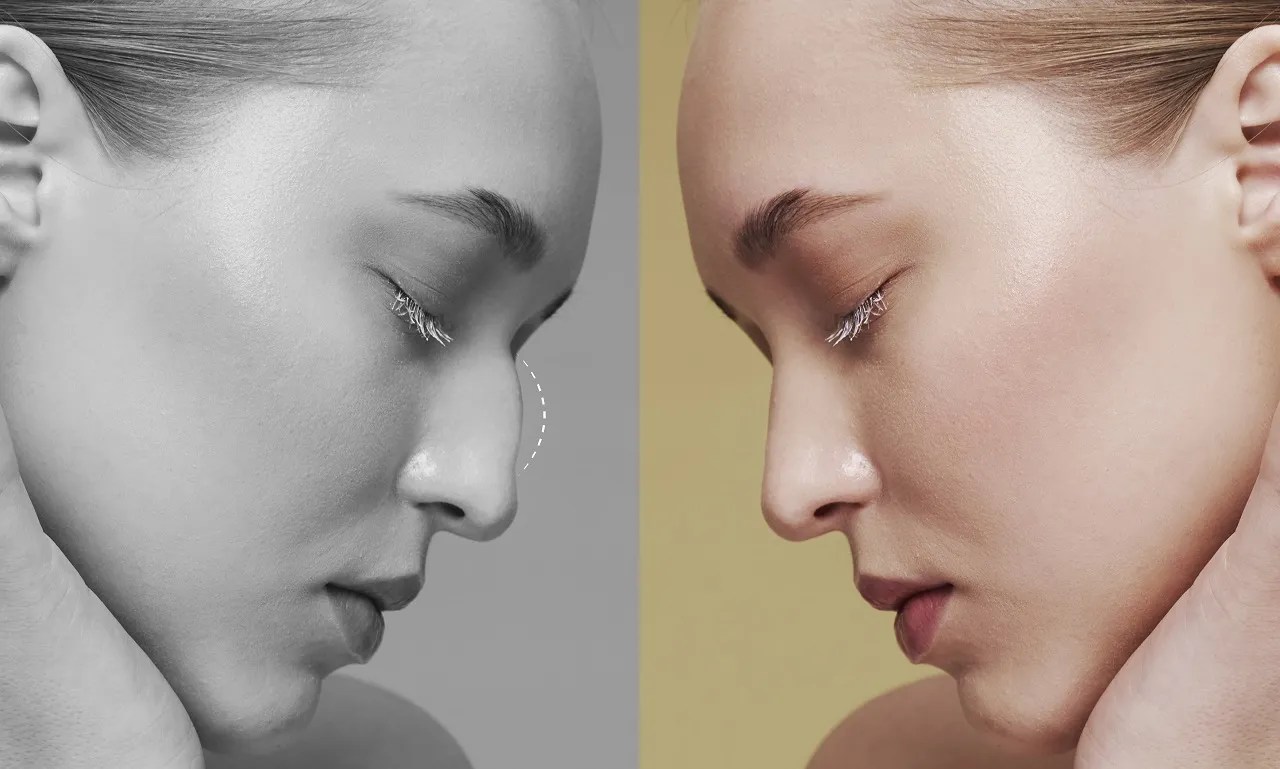 What is Nose Type Chart What Does It Mean