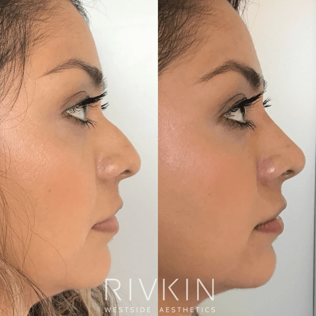 Hispanic Nose RIVKIN Aesthetics