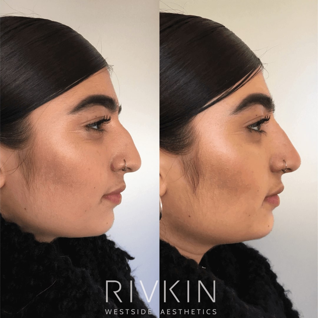 Hispanic Nose RIVKIN Aesthetics