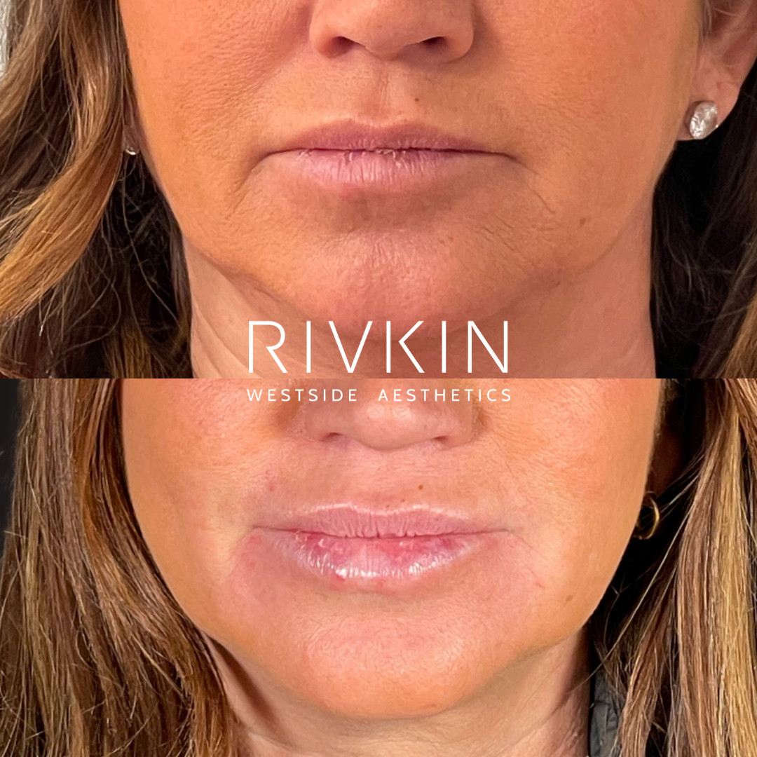 Radiesse Lines Before After