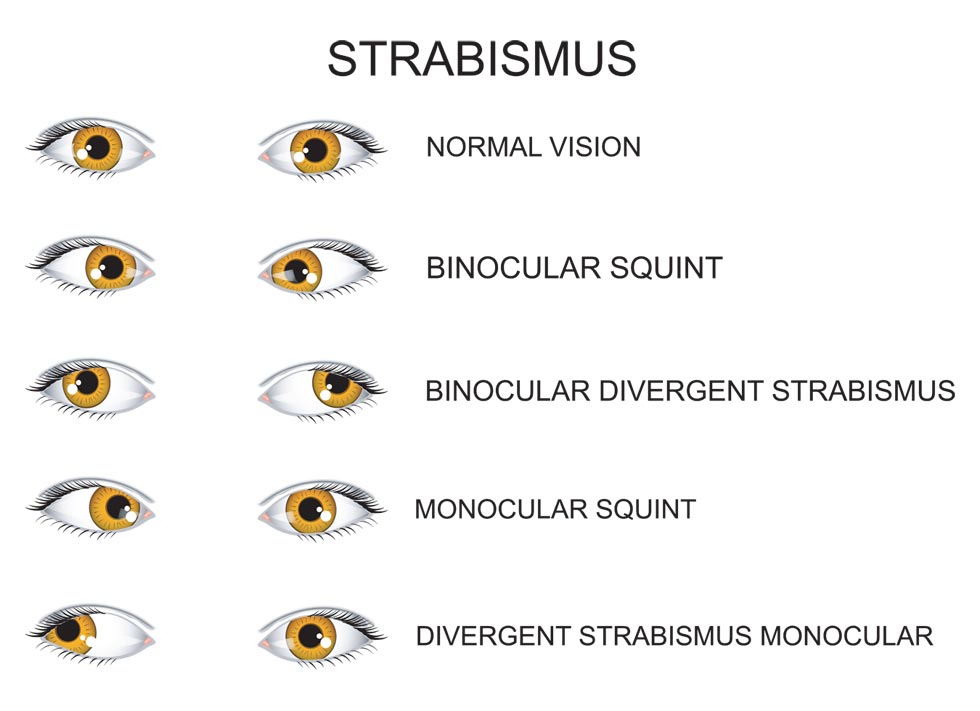 Muscle Surgery Westside Eye Clinic of New Orleans