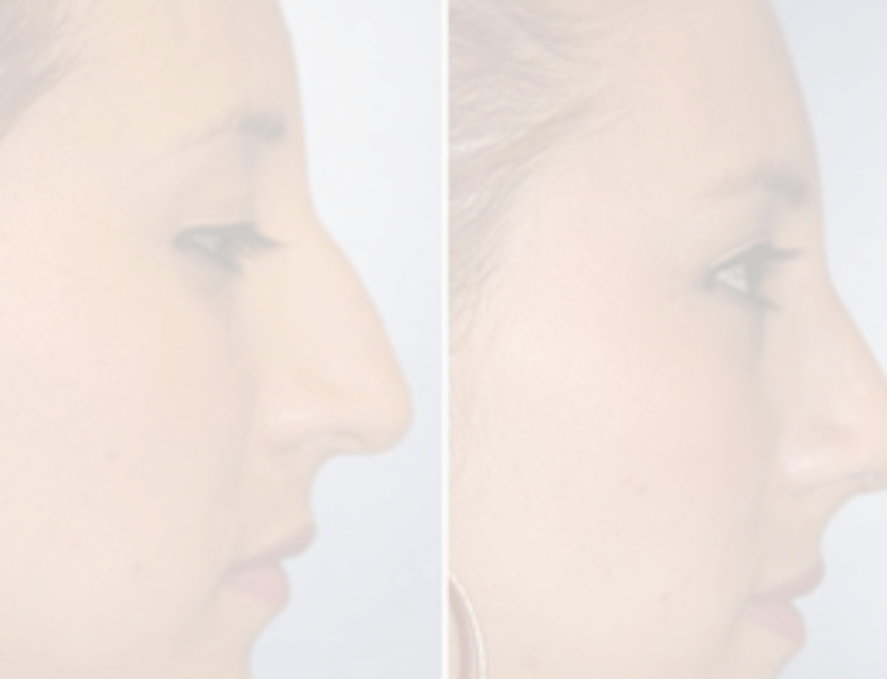 SAME DAY BROKEN NOSE REPAIR Westside Sinus