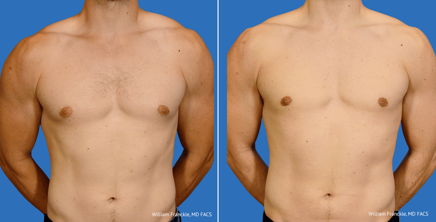 Male Breast Reduction Before And After Voorhees, NJ, South Jersey William