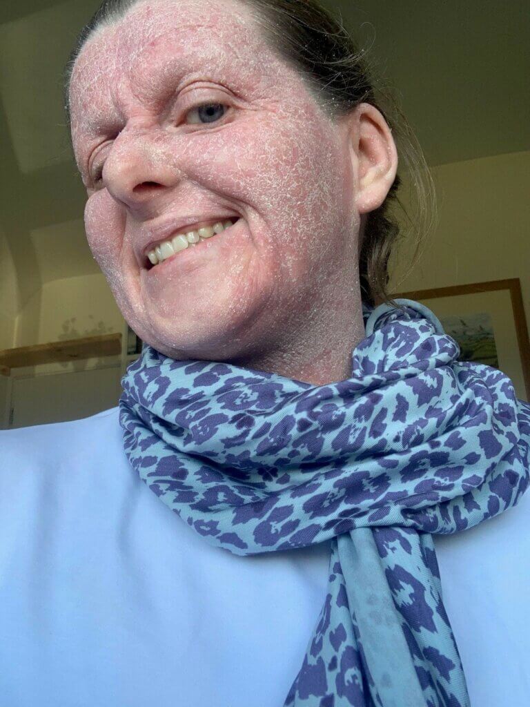 Can a water softener help eczema? What Allergy Blog