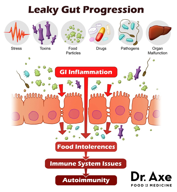 What Exactly Is Leaky Gut And How Do I Start Healing It? What's With