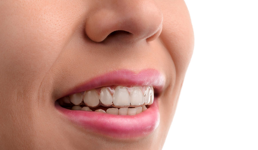 Invisalign Movement Per Tray? How Long Does it Take?