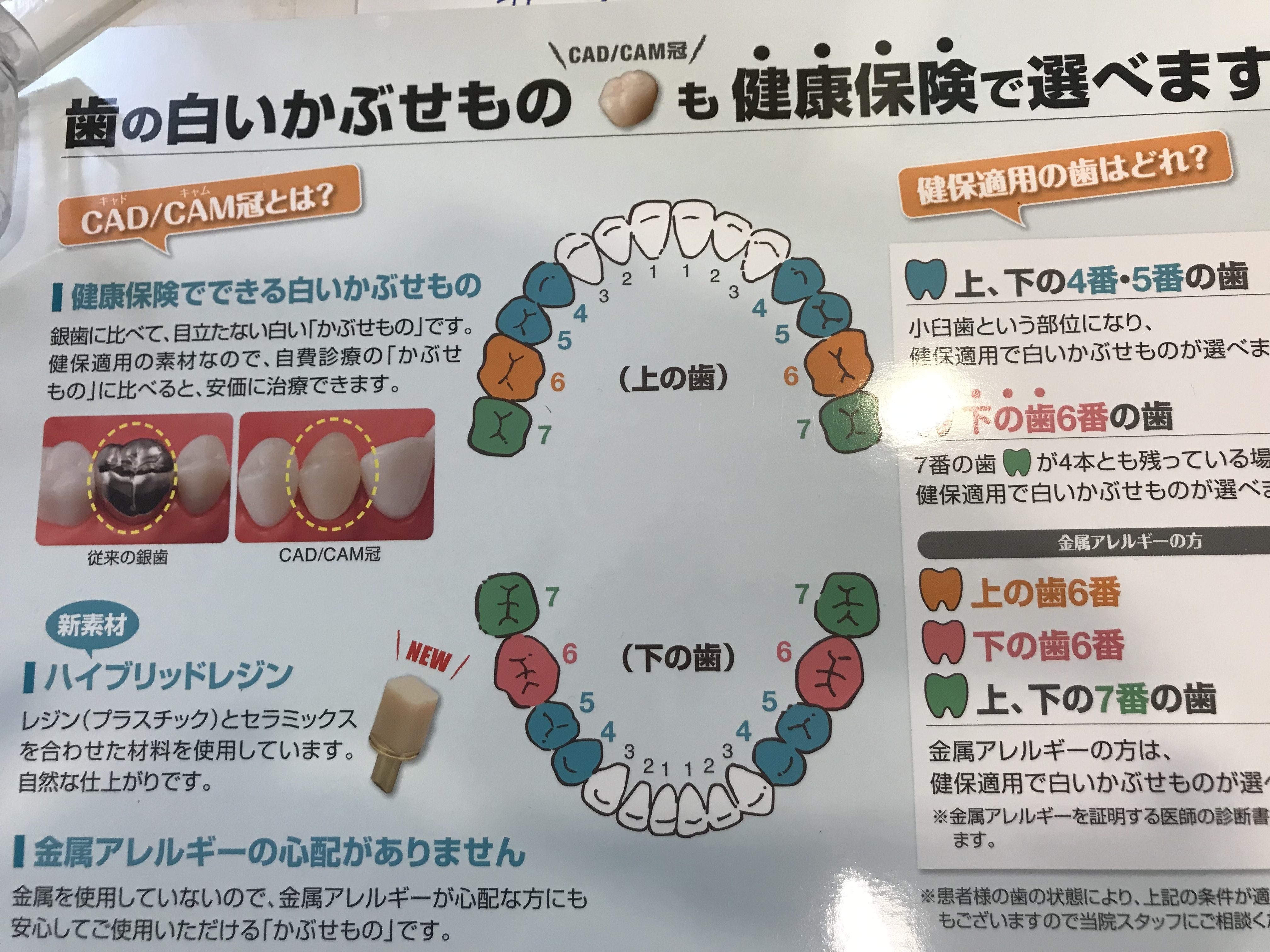 ハイブリッドレジン