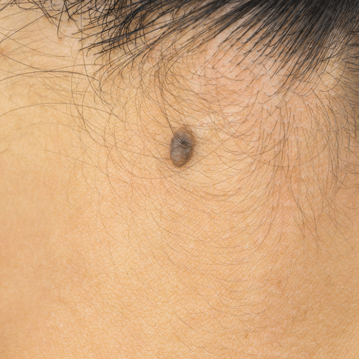 Moles White Rock Dermatology Mole Evaluation in Dallas, TX