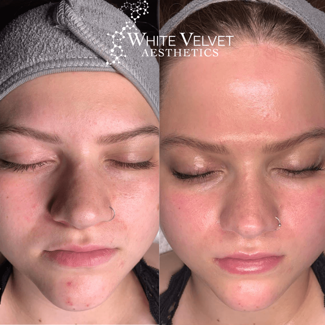 Facials Facials Billings, MT White Velvet Aesthetics