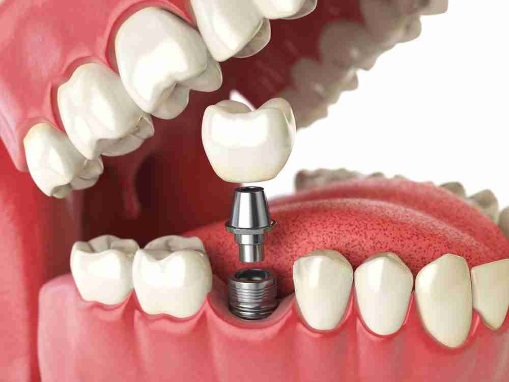 The Benefits of Dental Implants Over Dental Bridges Whiting Dental
