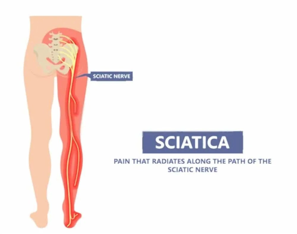Does Sciatica Go Away Gradually? No, It Takes 3 Simple Steps